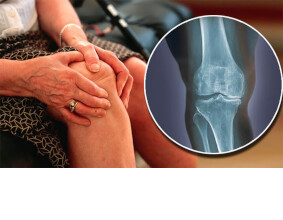 Ученые доказали эффективность лечения пиявками при лечении коленного сустава